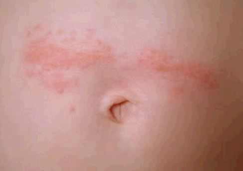 Painful, Itchy Patches Could Be Sign of Skin Cancer – WebMD