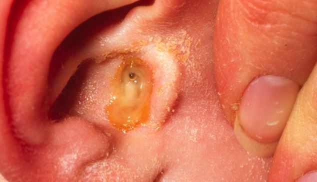 Ear canal infection | Health24