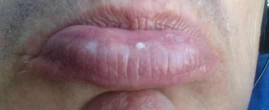  spots inside lower upper lips click for details fordyce spots on lips