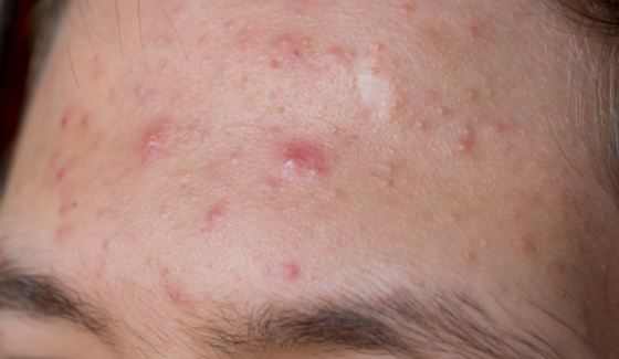 Bumps on Forehead, Small Spots, Get Rid of Little Hard ...