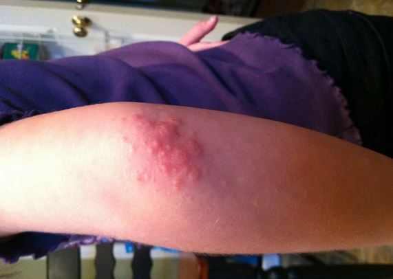 rash on inside of elbows #10