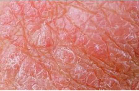 Herpes Pictures | What do herpes sores look like?
