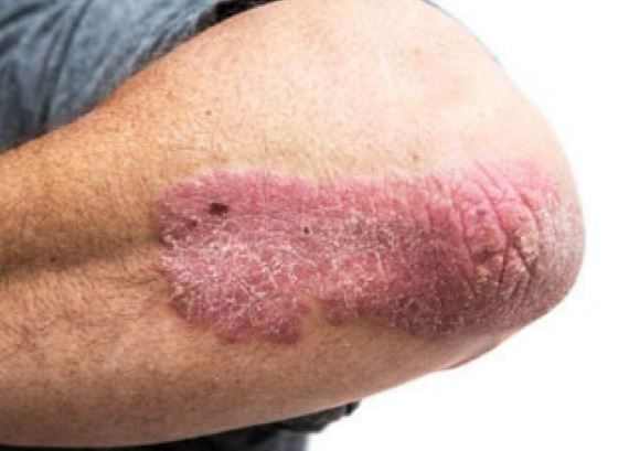 What causes a rash behind the knees?