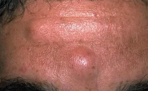 Bumps On Forehead Small Spots Get Rid Of Little Hard Lump On Forehead