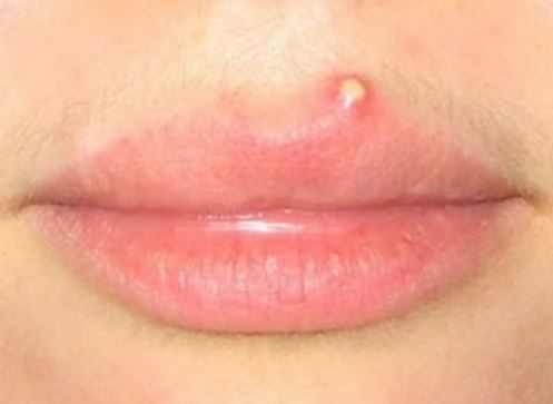 Mouth Sores: Definition, Treatments, & Causes - Healthline