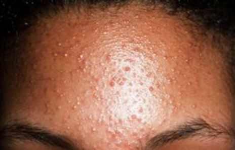 What Are These Bumps on my Forehead? (photo) Doctor ...