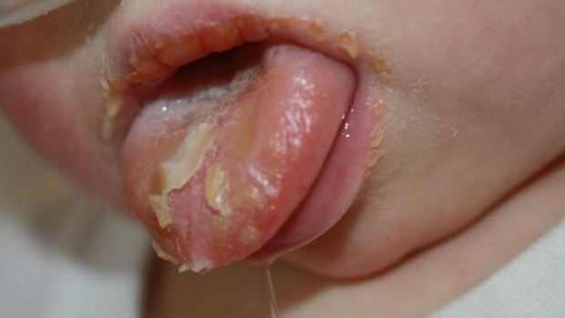Peeling Lips – Mouth conditions – Condition | Our Health