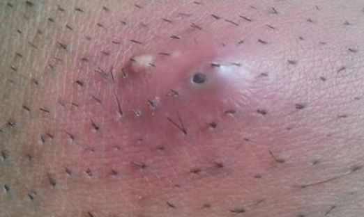 infected hair follicles on head - pictures, photos