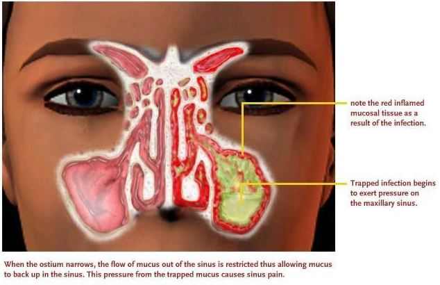 Throat Virus Greenish Mucous 70