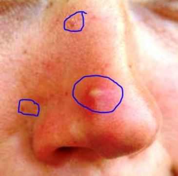 Infected Pore on Nose