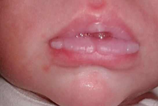 Milk blister on baby lip