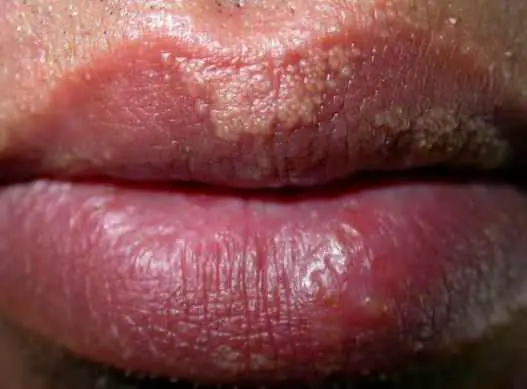 Fordyce spots on lower and upper lips