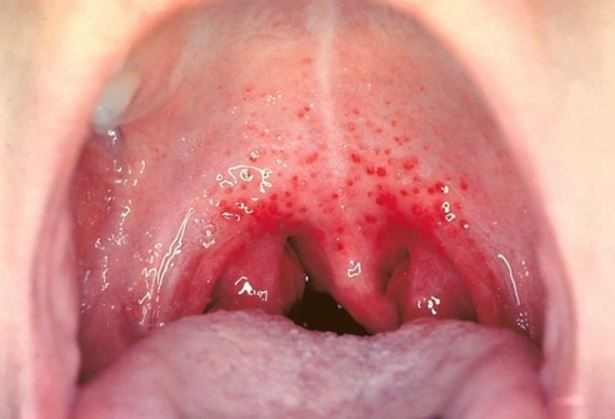 Red spots on roof of mouth with no pain
