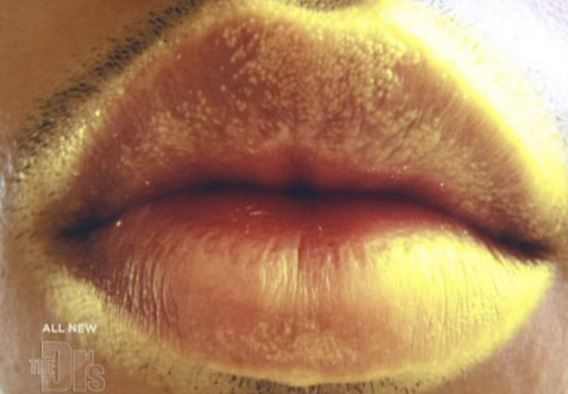 white fordyce granules on lips above and below