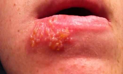 White spots on lips from cold sores