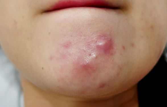 Deep-cystic-pimples-on-chin
