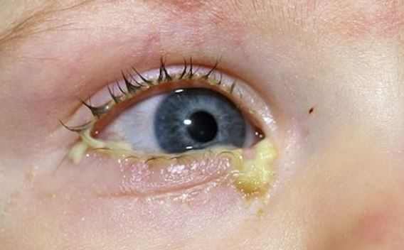 Mucus in eye - discharge from baby eyes