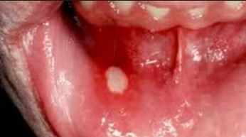 Oral thrush, affects mostly babies