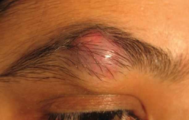 Infected ingrown hair on eyebrow area
