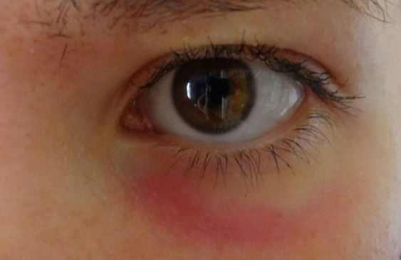 Red circles around eyes