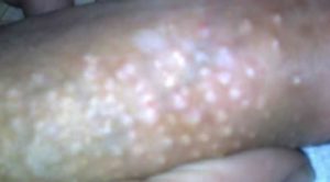 my get How dick rid on to of pimples