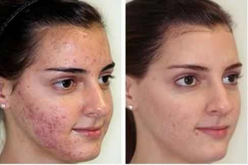 before-and-after-microdermabrasion