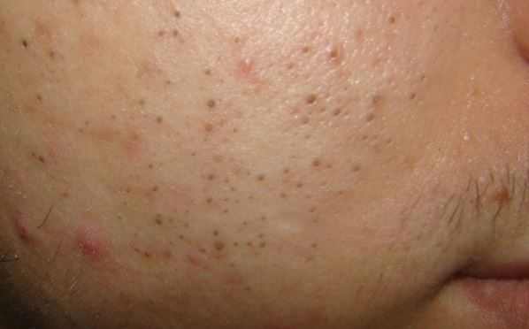 How to remove black spots on face from pimples