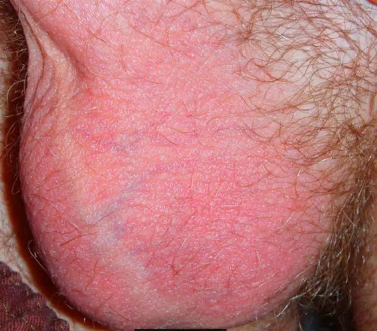 Rash on Scrotum, Testicles or Under Balls, Itchy Crotch Red 