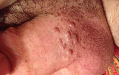 Small Hard White Bump on Testicles, Scrotum Balls
