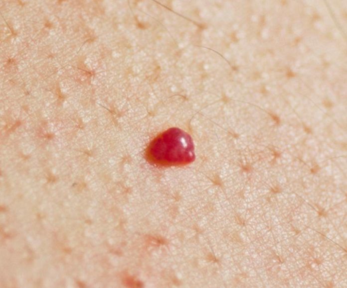 How to Get Rid of Red Moles on Scalp Skin, Body