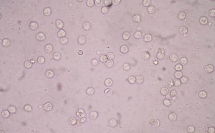 White Blood Cells in Urine Meaning, Causes