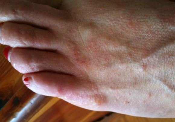 Itchy Bumps on Feet, Small, Fluid Filled Bumps That Hurt on Feet