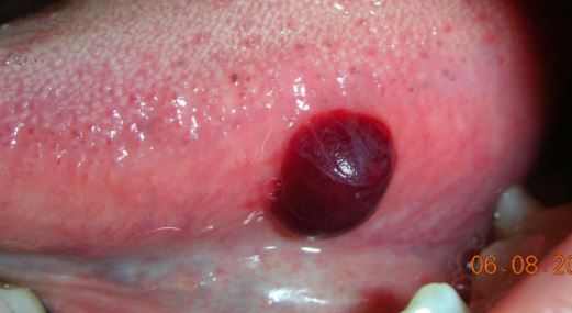 Blood blister on tongue