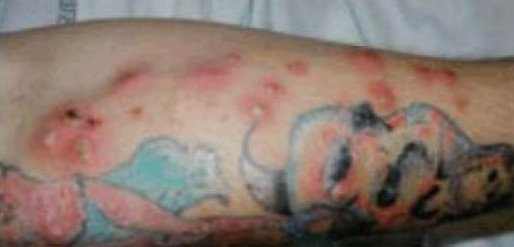 Bump On Tattoo, Little, White, Red, Painful, Small Bumps, Infected, Itchy,  Causes, Under Tattoo, Causes, How to Get Rid