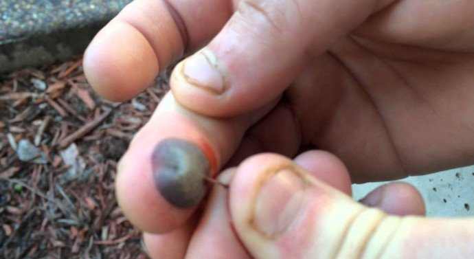 how to pop a blood blister