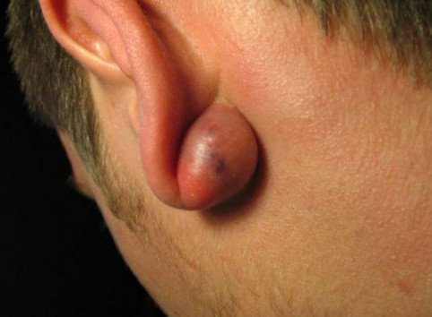 earlobe cyst
