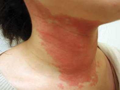 rash on neck