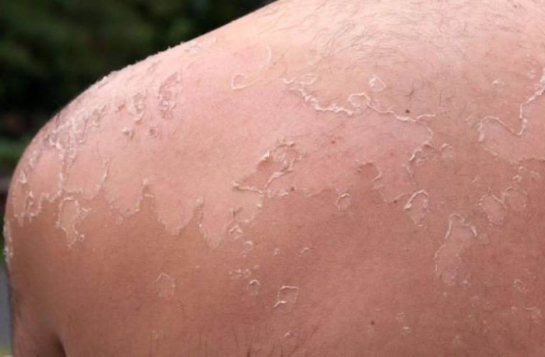 Sunburn Itch (Hell’s Itch): Causes, Symptoms & How to Get Rid of It