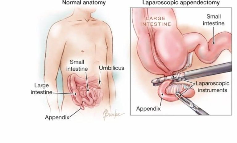 Appendectomy Recovery Time: When Can You Go Back to Work After Surgery