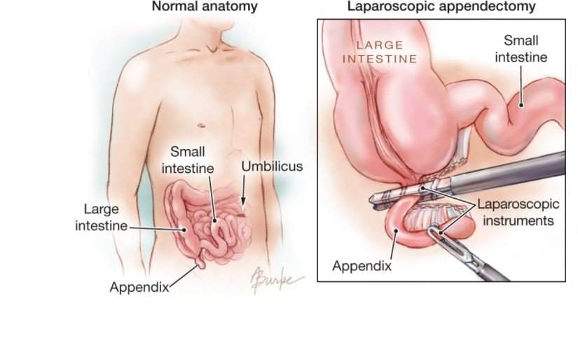 how long is recovery from laparoscopic appendectomy