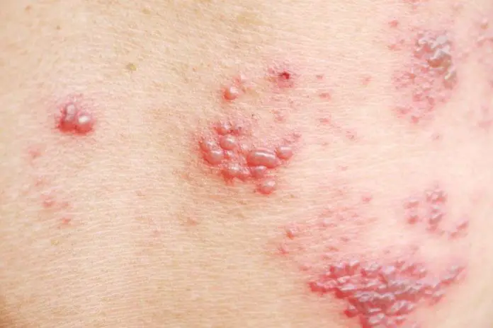 How to get rid of shingles in 3 days