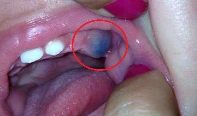 Purple gums or dark spots on gums