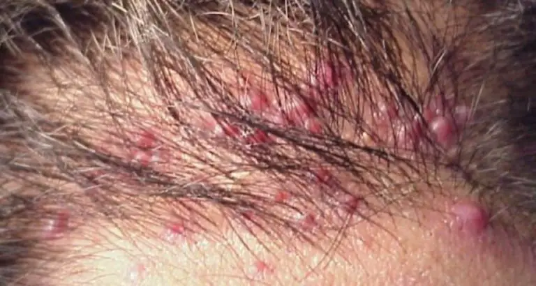 Swollen Hair Follicle on Scalp, Groin, Thigh, Pubic Area, Causes, Treatment for Inflamed Hair Follicles