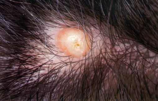 Ingrown-hair-cyst-on-scalp
