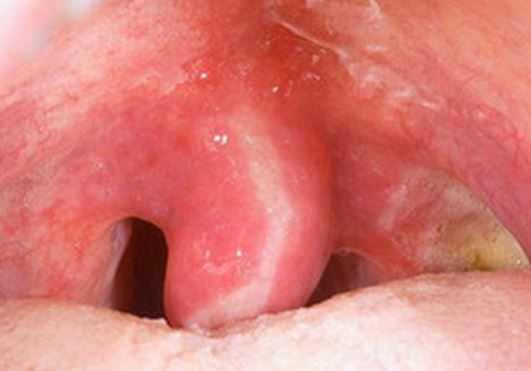 Swollen-uvula
