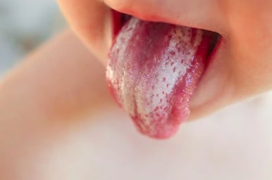 baby mouth thrush Causes, treatment and home remedies