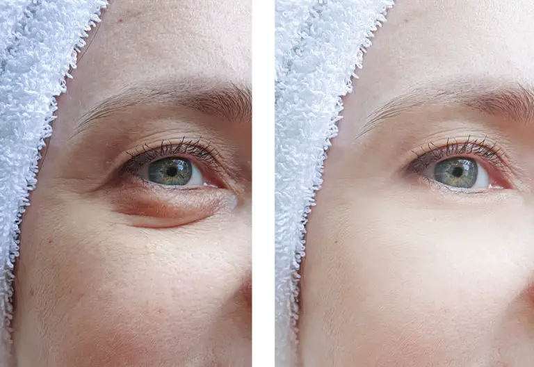 6 Ways to Get Rid of Bags Under Your Eyes