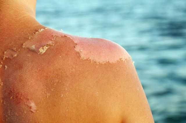 How to Treat a Sunburn | What is a Sunburn? | SPF/Sunscreen Info