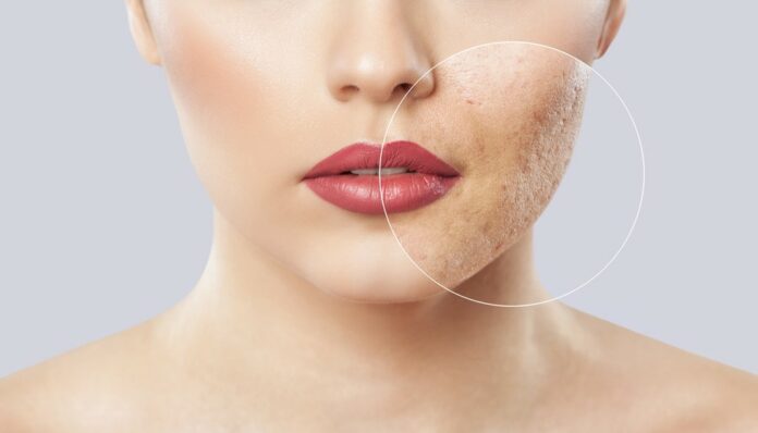 skin laser treatment