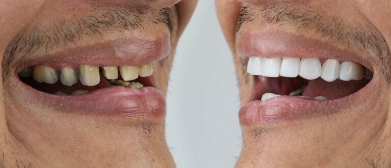 How To Achieve The Ultimate Smile Makeover